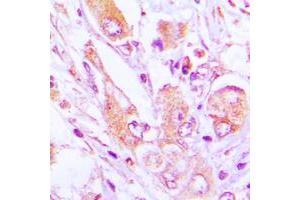 Immunohistochemical analysis of MRPS35 staining in human lung cancer formalin fixed paraffin embedded tissue section. (MRPS35 anticorps  (Center))