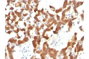 Formalin-fixed, paraffin-embedded human Thyroid Carcinoma stained with Cytokeratin 18 Mouse Monoclonal Antibody (KRT18/834).