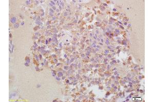 Formalin-fixed and paraffin embedded human bladder cancer labeled with Rabbit Anti-MMP-13 Polyclonal Antibody, Unconjugated  at 1:200 followed by conjugation to the secondary antibody and DAB staining