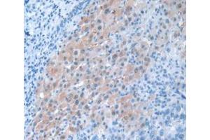 IHC-P analysis of Human Liver Cancer Tissue, with DAB staining. (PANX1 anticorps  (AA 228-411))