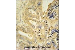TLL1 antibody (C-term) (ABIN654712 and ABIN2844401) immunohistochemistry analysis in formalin fixed and paraffin embedded human prostate carcinoma followed by peroxidase conjugation of the secondary antibody and DAB staining. (TLL1 anticorps  (C-Term))