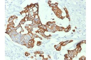 Formalin-fixed, paraffin-embedded human Colon Carcinoma stained with Cytokeratin 20 (KRT20) Mouse Monoclonal Antibody (KRT20/1992). (KRT20 anticorps  (AA 196-323))