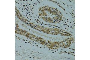 Immunohistochemistry of paraffin-embedded human breast cancer using RSRC1 antibody (ABIN5974341) at dilution of 1/100 (40x lens). (RSRC1 anticorps)