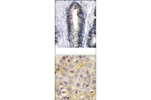 (TOP)Formalin-fixed and paraffin-embedded human breast carcinoma reacted with EphB2 Antibody (C-term), which was peroxidase-conjugated to the secondary antibody, followed by DAB staining.