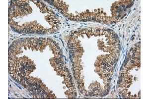 Immunohistochemical staining of paraffin-embedded Carcinoma of Human liver tissue using anti-RAB17 mouse monoclonal antibody. (RAB17 anticorps)