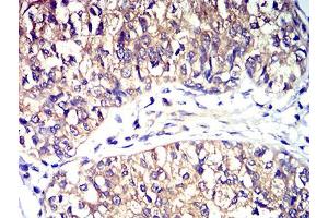 Immunohistochemical analysis of paraffin-embedded bladder cancer tissues using CD195 mouse mAb with DAB staining.