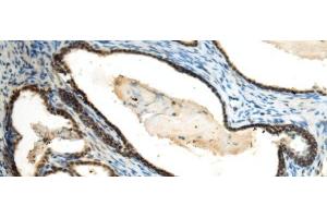 Immunohistochemistry of paraffin-embedded Human prost at e cancer tissue using SUV39H2 Polyclonal Antibody at dilution of 1:70(x200) (SUV39H2 anticorps)