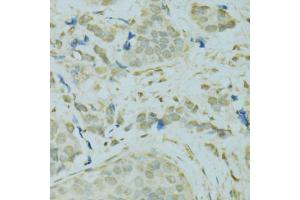 Immunohistochemistry of paraffin-embedded human breast cancer using SAFB antibody (ABIN5975793) at dilution of 1/100 (40x lens). (SAFB anticorps)