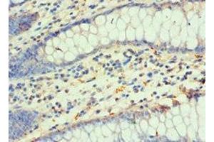 Immunohistochemistry of paraffin-embedded human colon cancer using ABIN7155678 at dilution of 1:100