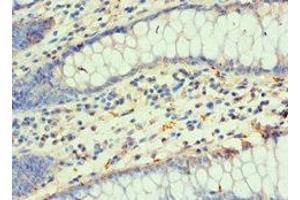 Immunohistochemistry of paraffin-embedded human colon cancer using ABIN7155678 at dilution of 1:100 (DLX3 anticorps  (AA 1-120))
