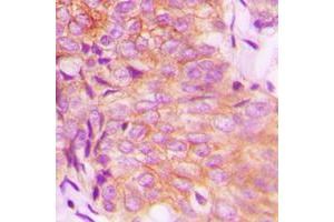 Immunohistochemical analysis of EPS8L3 staining in human breast cancer formalin fixed paraffin embedded tissue section. (EPS8-Like 3 anticorps  (Center))