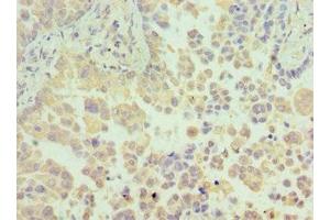 Immunohistochemistry of paraffin-embedded human lung cancer using ABIN7154967 at dilution of 1:100 (N6AMT1 anticorps  (AA 1-186))
