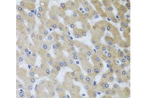 Immunohistochemistry of paraffin-embedded Human liver damage using UVRAG Polyclonal Antibody at dilution of 1:100 (40x lens). (UVRAG anticorps)