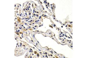 Immunohistochemistry of paraffin-embedded human lung cancer using WNT3A antibody at dilution of 1:200 (400x lens). (WNT3A anticorps)