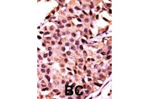 Formalin-fixed and paraffin-embedded human cancer tissue reacted with the primary antibody, which was peroxidase-conjugated to the secondary antibody, followed by AEC staining.