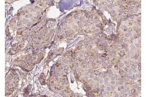 ABIN6272946 at 1/100 staining Human breast cancer tissue by IHC-P. (PPFIA1 anticorps  (C-Term))