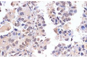 Immunohistochemistry of paraffin-embedded Human lung cancer using PIDD Polyclonal Antibody at dilution of 1:100 (40x lens). (PIDD anticorps)