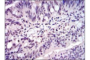 Immunohistochemical analysis of paraffin-embedded rectum cancer tissues using SKP1 mouse mAb with DAB staining.