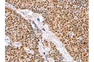The image on the left is immunohistochemistry of paraffin-embedded Human lung cancer tissue using ABIN7129916(IRF6 Antibody) at dilution 1/50, on the right is treated with fusion protein. (IRF6 anticorps)