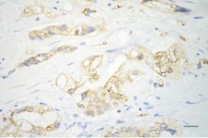 Immunohistochemistry was performed on paraffin-embedded human pancreatic adenocarcinoma using sonic hedgehog antibody (ABIN7800969), 1:200).