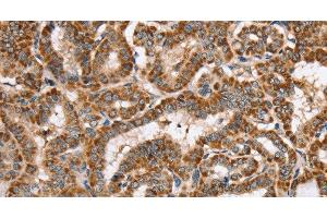 Immunohistochemistry of paraffin-embedded Human thyroid cancer using PPOX Polyclonal Antibody at dilution of 1:40 (PPOX anticorps)