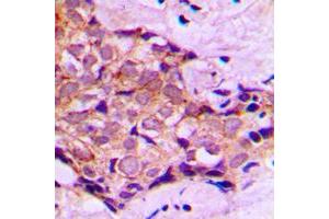 Immunohistochemical analysis of DNAL4 staining in human breast cancer formalin fixed paraffin embedded tissue section.