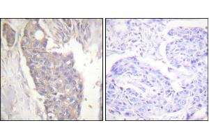Immunohistochemistry analysis of paraffin-embedded human breast carcinoma tissue using Fas antibody. (FAS anticorps)