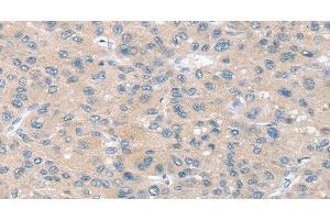 Immunohistochemistry of paraffin-embedded Human liver cancer using SLIT2 Polyclonal Antibody at dilution of 1:30 (SLIT2 anticorps)