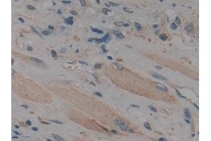 Detection of MAPK11 in Human Prostate cancer Tissue using Polyclonal Antibody to Mitogen Activated Protein Kinase 11 (MAPK11)