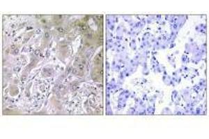 Immunohistochemistry analysis of paraffin-embedded human liver carcinoma tissue using ACOT12 antibody. (ACOT12 anticorps)