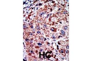 Formalin-fixed and paraffin-embedded human cancer tissue reacted with the primary antibody, which was peroxidase-conjugated to the secondary antibody, followed by AEC staining.