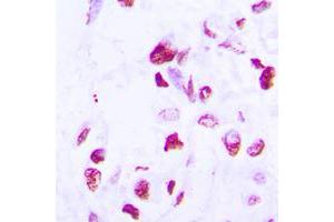 Immunohistochemical analysis of C/EBP delta/epsilon staining in human lung cancer formalin fixed paraffin embedded tissue section. (C/EBP delta/epsilon (C-Term) anticorps)