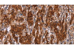 Immunohistochemistry of paraffin-embedded Human gastric cancer tissue using GCKR Polyclonal Antibody at dilution 1:50 (GCKR anticorps)
