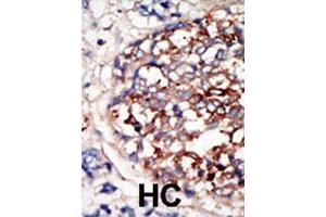 Formalin-fixed and paraffin-embedded human hepatocellular carcinoma tissue reacted with DYRK1B polyclonal antibody  , which was peroxidase-conjugated to the secondary antibody, followed by DAB staining. (DYRK1B anticorps  (C-Term))