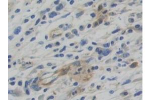 Detection of WARS in Human Stomach cancer Tissue using Polyclonal Antibody to Tryptophanyl tRNA Synthetase (WARS)