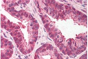 Human Prostate (formalin-fixed, paraffin-embedded) stained with TMED10 antibody ABIN214530 at 3 ng/ul followed by biotinylated goat anti-rabbit IgG secondary antibody ABIN481713, alkaline phosphatase-streptavidin and chromogen. (TMED10 anticorps  (C-Term))