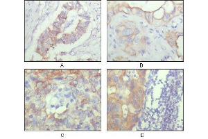 Immunohistochemical analysis of paraffin-embedded human ovary carcinoma (A), kidney carcinoma (B), lung carcinoma (C) and breast carcinoma (D), showing cytoplasmic and membrane localization with DAB staining using ALCAM mouse mAb. (CD166 anticorps  (AA 405-524))