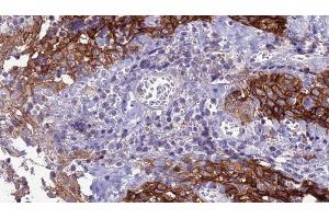 ABIN6277924 at 1/100 staining Human Head and neck cancer tissue by IHC-P. (SLC39A8 anticorps  (Internal Region))