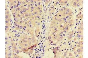 Immunohistochemistry of paraffin-embedded human liver cancer using ABIN7144950 at dilution of 1:100