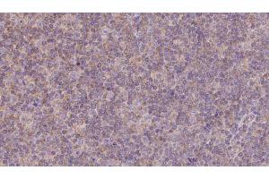 ABIN6273141 at 1/100 staining Human lymph cancer tissue by IHC-P.