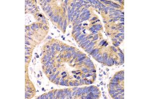 Immunohistochemistry of paraffin-embedded human colon carcinoma using HMGCL antibody (ABIN5975709) at dilution of 1/100 (40x lens). (HMGCL anticorps)