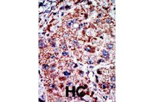 Formalin-fixed and paraffin-embedded human hepatocellular carcinoma tissue reacted with PFKL polyclonal antibody  , which was peroxidase-conjugated to the secondary antibody, followed by AEC staining. (PFKL anticorps  (C-Term))