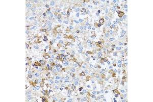 Immunohistochemistry of paraffin-embedded human lung cancer using ACTR2 antibody. (ACTR2 anticorps  (AA 1-160))