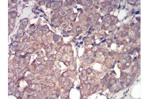 Immunohistochemical analysis of paraffin-embedded breast cancer tissues using IRAK3 mouse mAb with DAB staining. (IRAK3 anticorps  (AA 454-596))