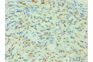 Immunohistochemistry of paraffin-embedded human breast cancer using ABIN7144142 at dilution of 1:100 (SLC4A2 anticorps  (AA 95-245))