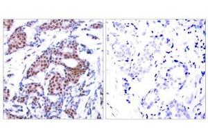Immunohistochemical analysis of paraffin-embedded human breast carcinoma tissue using Elk-1 (phospho-Ser383) antibody (E011004). (ELK1 anticorps  (pSer383))