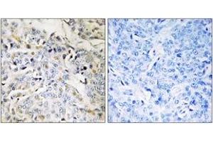 Immunohistochemistry analysis of paraffin-embedded human breast carcinoma tissue, using RBM34 Antibody. (RBM34 anticorps  (AA 345-394))