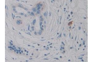 Detection of IL2 in Human Pancreatic cancer Tissue using Monoclonal Antibody to Interleukin 2 (IL2) (IL-2 anticorps  (AA 21-153))