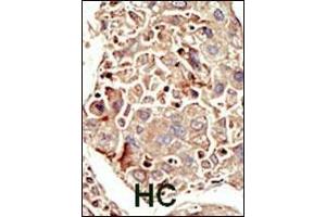 Formalin-fixed and paraffin-embedded human cancer tissue reacted with the primary antibody, which was peroxidase-conjugated to the secondary antibody, followed by DAB staining.