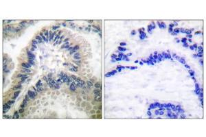 Immunohistochemical analysis of paraffin-embedded human lung carcinoma tissue using Guanylate Cyclase beta antibody (ABIN5976418). (GUCYB anticorps  (N-Term))
